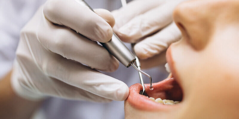 sacar muela con endodoncia