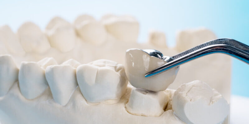 que es corona dental